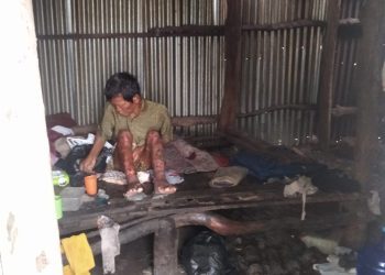SEDIH,,Warga Plaju Darat Sangat di Prihtin Dengan Kondisi SakitMengidap Infeksi Penyakit Kulit