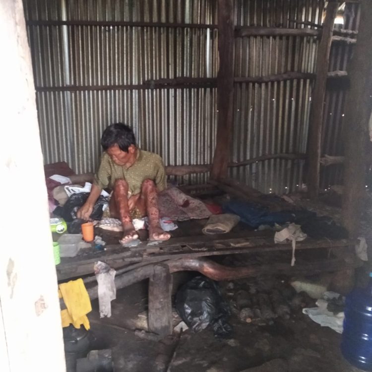 SEDIH,,Warga Plaju Darat Sangat di Prihtin Dengan Kondisi SakitMengidap Infeksi Penyakit Kulit